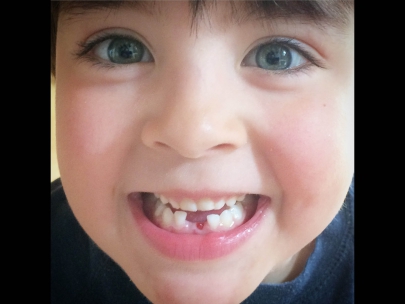 but not for long... second tooth out!
