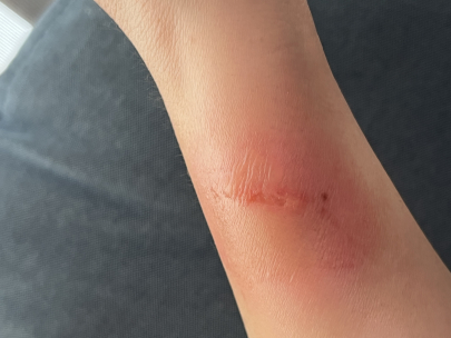 burned